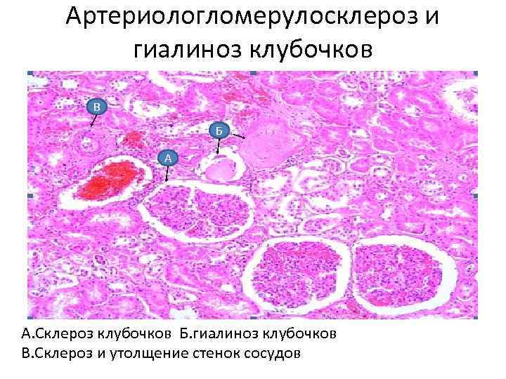 Артериологломерулосклероз и гиалиноз клубочков В Б А А. Склероз клубочков Б. гиалиноз клубочков В.