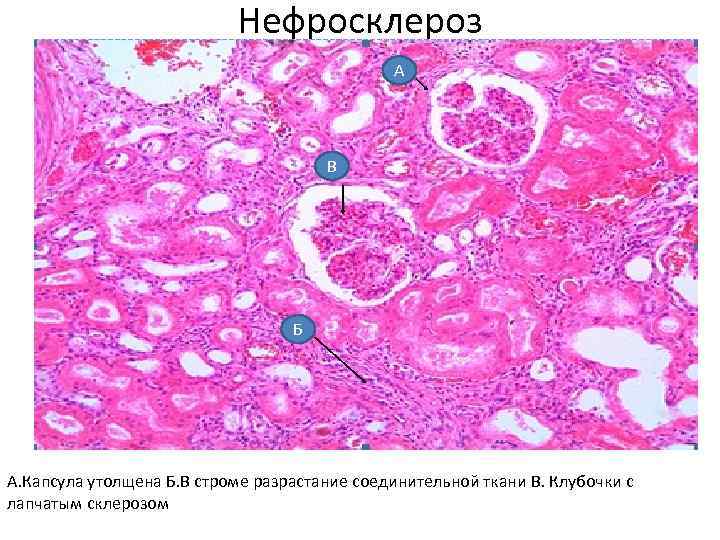  • ка Нефросклероз А В Б А. Капсула утолщена Б. В строме разрастание