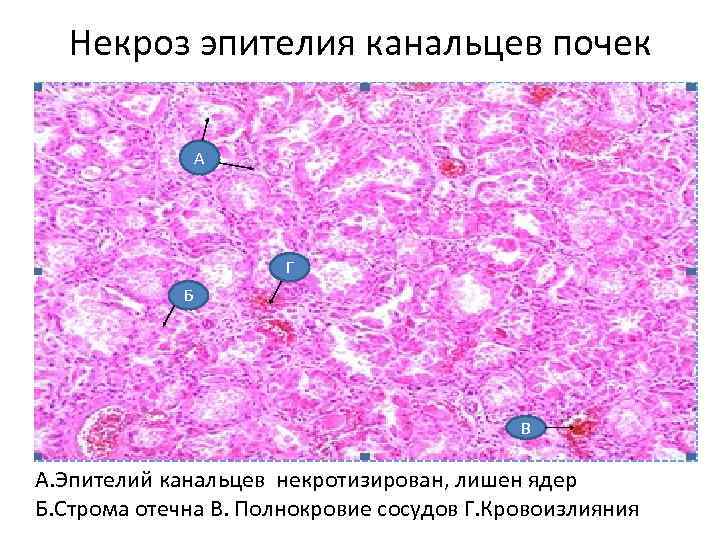 Некроз эпителия канальцев почек А Г Б В А. Эпителий канальцев некротизирован, лишен ядер
