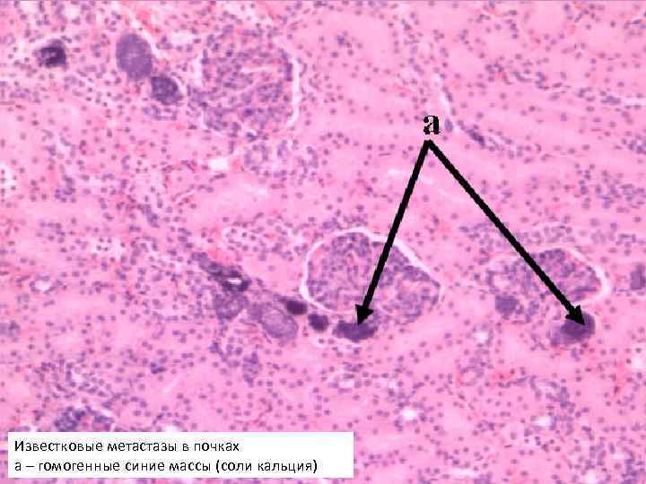 Известковые метастазы в почках а – гомогенные синие массы (соли кальция) 