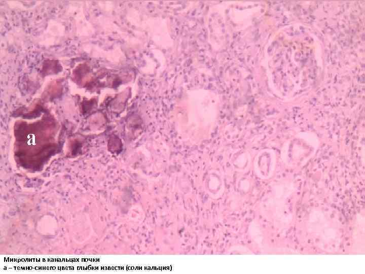 Микролиты в канальцах почки а – темно-синего цвета глыбки извести (соли кальция) 