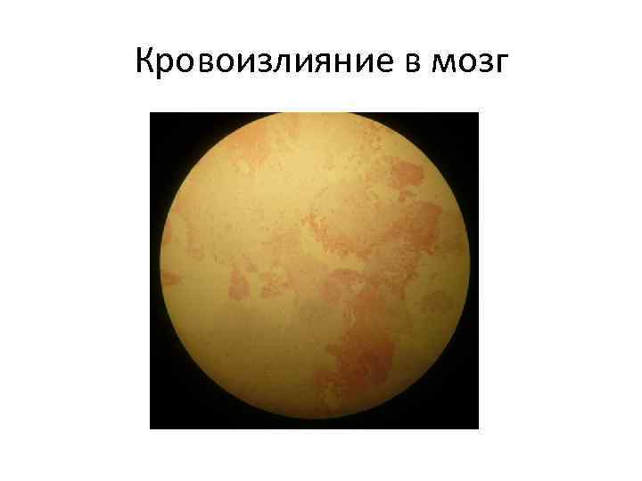 Кровоизлияние в мозг 