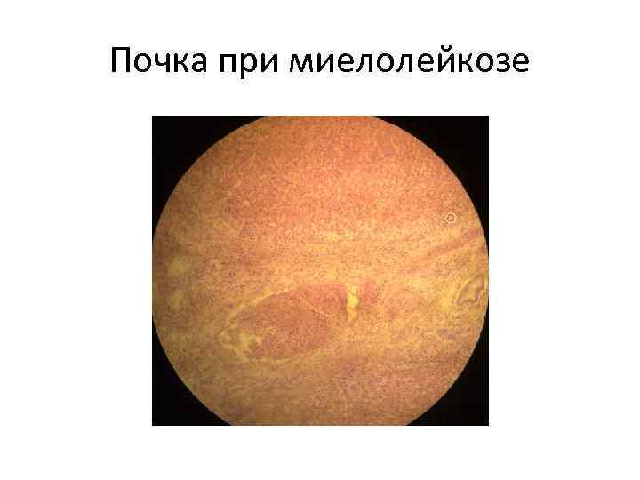 Почка при миелолейкозе 