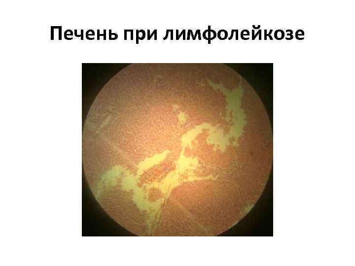 Печень при лимфолейкозе 