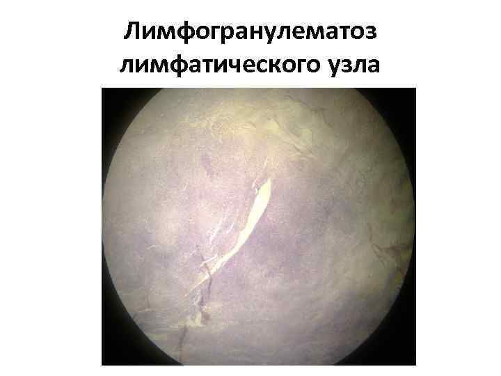 Лимфогранулематоз лимфатического узла 