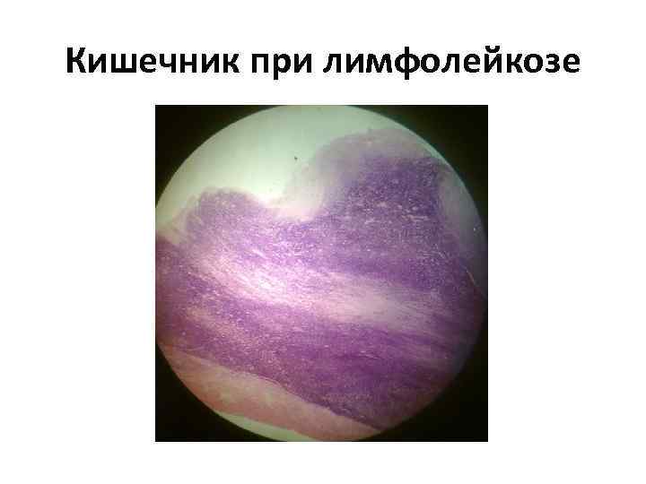 Кишечник при лимфолейкозе 