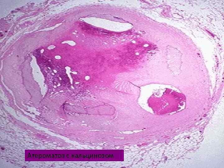 Атероматоз с кальцинозом 