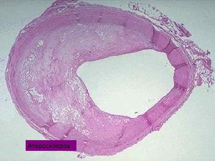 Атеросклероз 