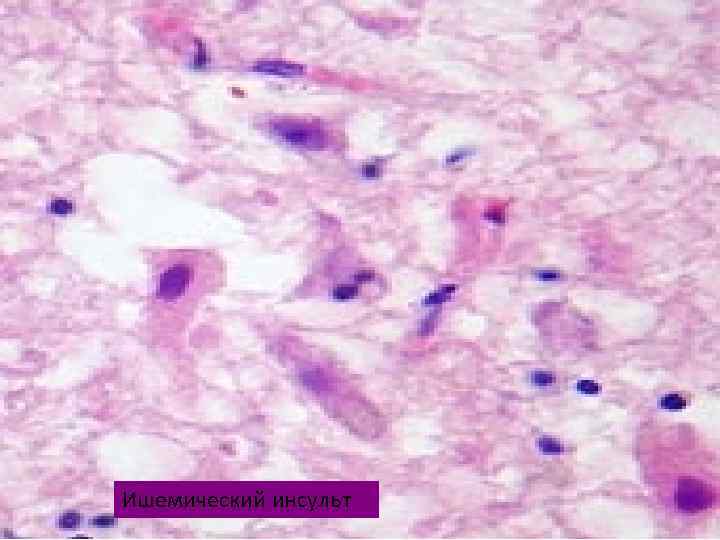 Ишемический инсульт 