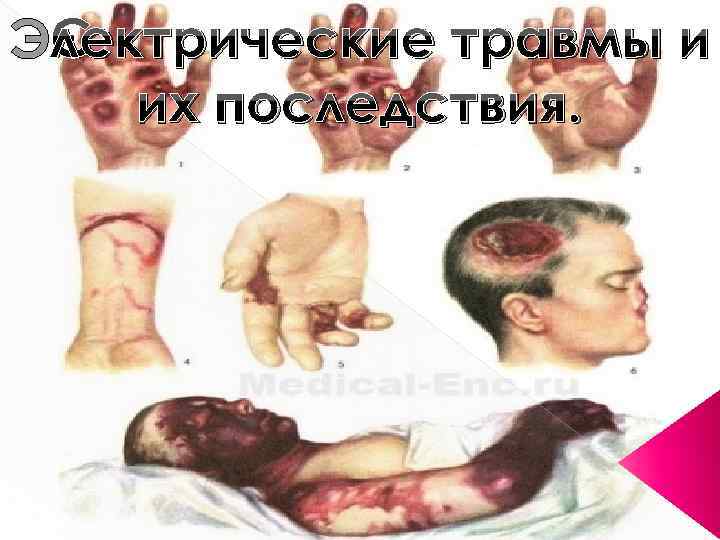 Электрические травмы и их последствия. 