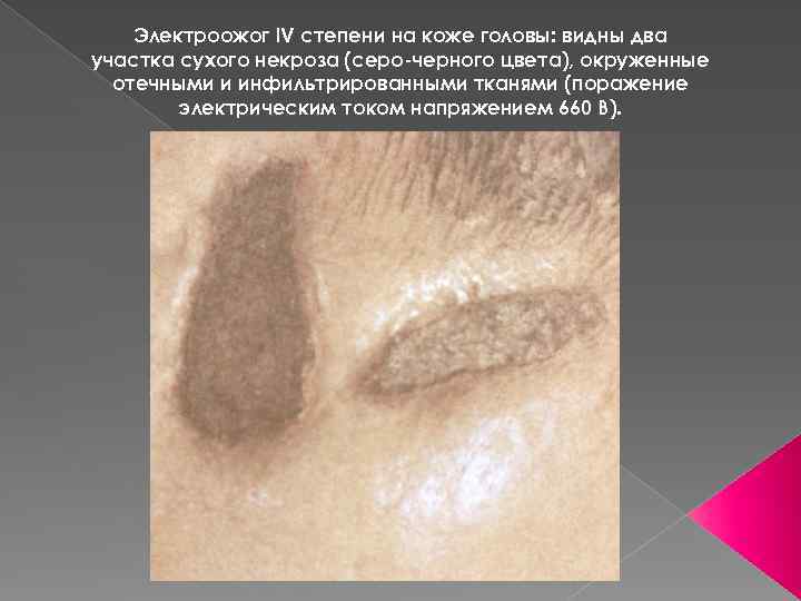 Электроожог IV степени на коже головы: видны два участка сухого некроза (серо-черного цвета), окруженные