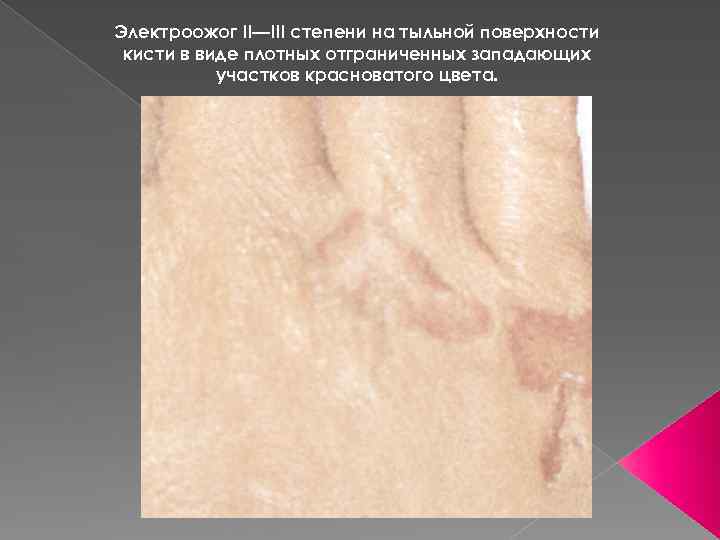Электроожог II—III степени на тыльной поверхности кисти в виде плотных отграниченных западающих участков красноватого