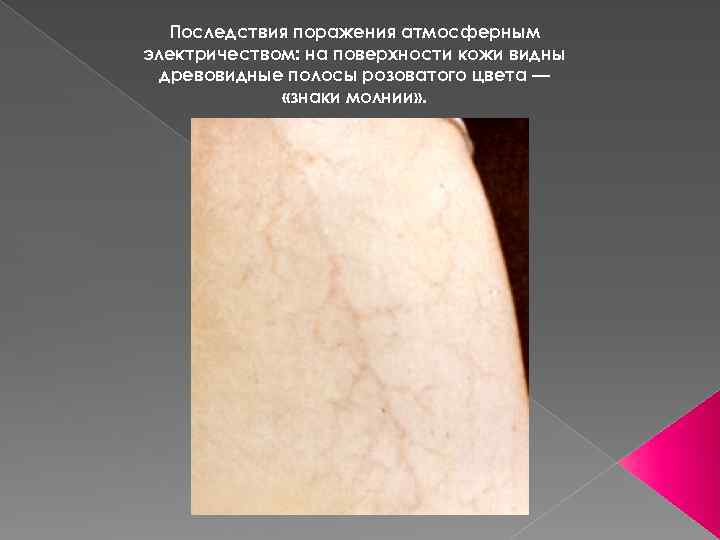 Последствия поражения атмосферным электричеством: на поверхности кожи видны древовидные полосы розоватого цвета — «знаки