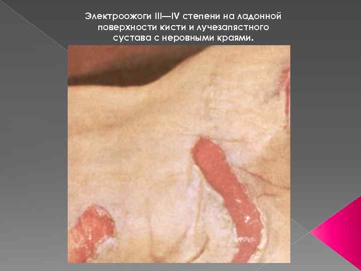 Электроожоги III—IV степени на ладонной поверхности кисти и лучезапястного сустава с неровными краями. 