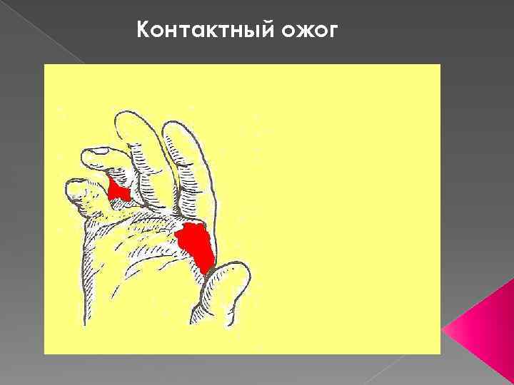Контактный ожог 