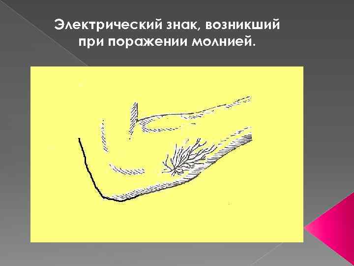Электрический знак, возникший при поражении молнией. 