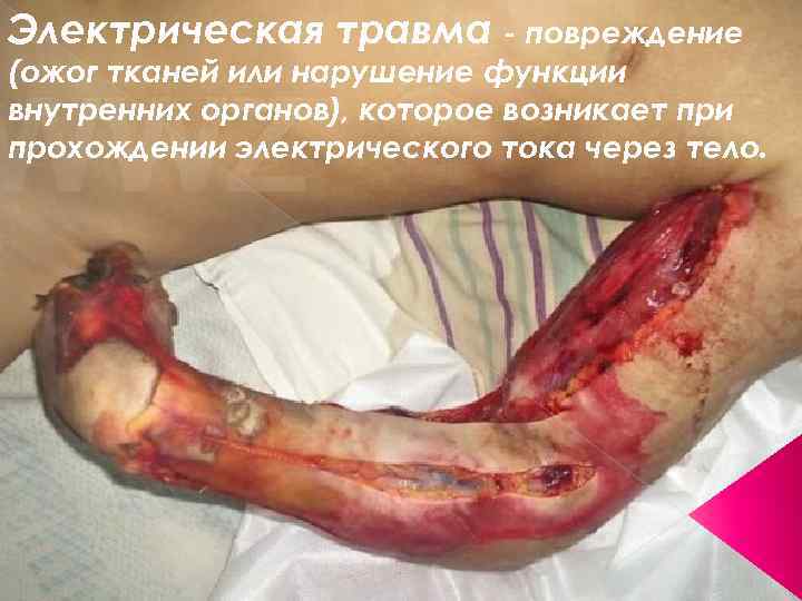 Электрическая травма - повреждение (ожог тканей или нарушение функции внутренних органов), которое возникает при