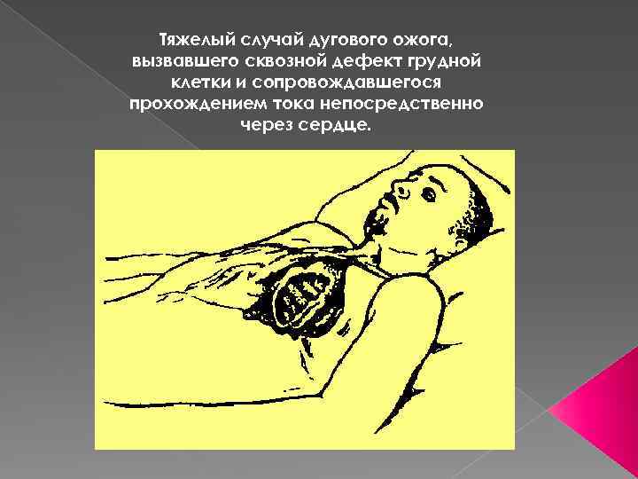 Тяжелый случай дугового ожога, вызвавшего сквозной дефект грудной клетки и сопровождавшегося прохождением тока непосредственно