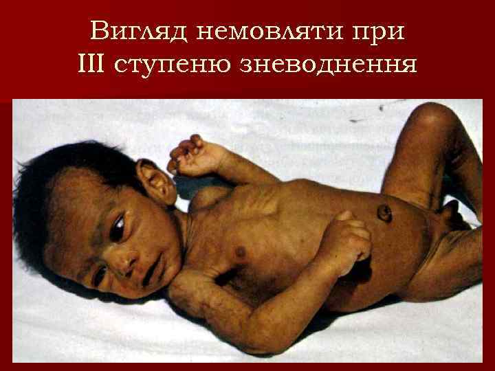 Вигляд немовляти при ІІІ ступеню зневоднення 
