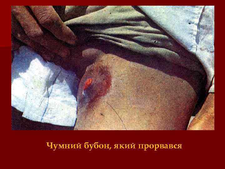 Чумний бубон, який прорвався 