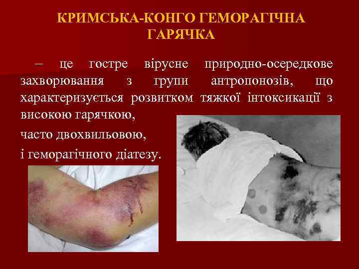 КРИМСЬКА-КОНГО ГЕМОРАГІЧНА ГАРЯЧКА – це гостре вірусне природно-осередкове захворювання з групи антропонозів, що характеризується