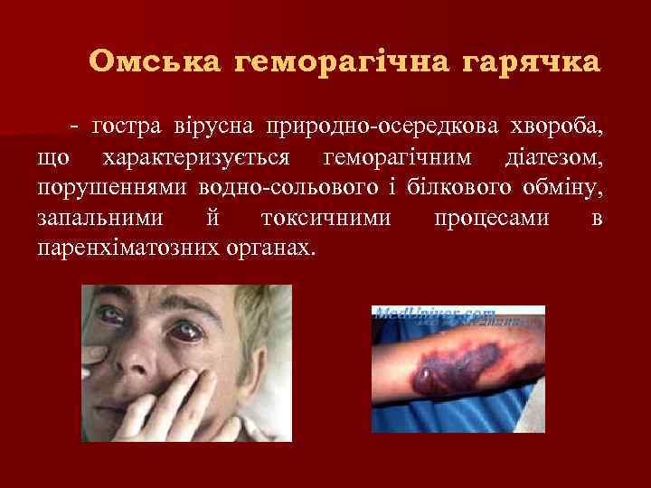 Омська геморагічна гарячка - гостра вірусна природно-осередкова хвороба, що характеризується геморагічним діатезом, порушеннями водно-сольового