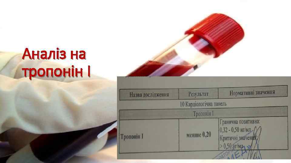 Аналіз на тропонін I 