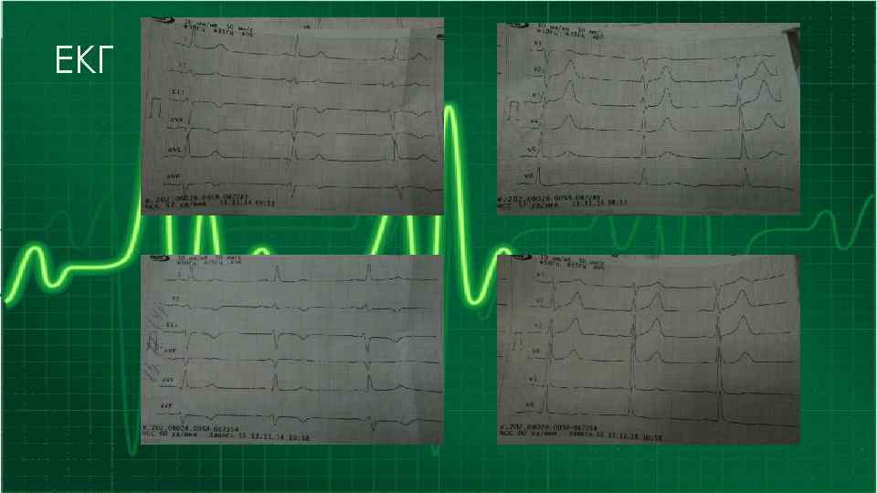 ЕКГ 