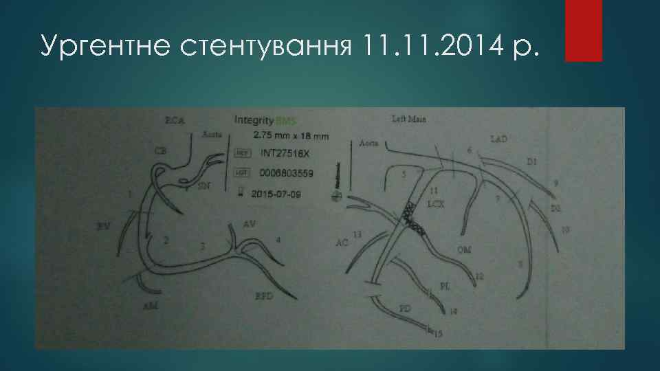 Ургентне стентування 11. 2014 р. 