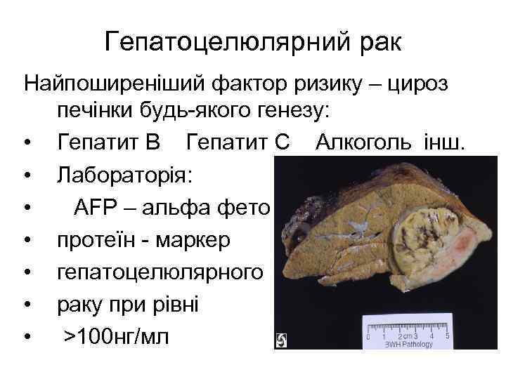 Гепатоцелюлярний рак Найпоширеніший фактор ризику – цироз печінки будь-якого генезу: • Гепатит B Гепатит