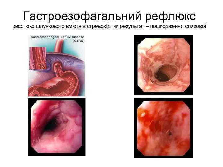 Гастроезофагальний рефлюкс шлункового вмісту в стравохід, як результат – пошкодження слизової 