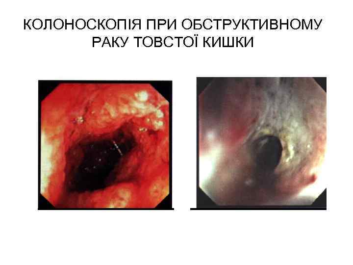 КОЛОНОСКОПІЯ ПРИ ОБСТРУКТИВНОМУ РАКУ ТОВСТОЇ КИШКИ 