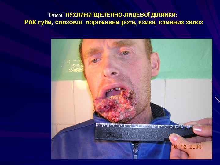 Тема: ПУХЛИНИ ЩЕЛЕПНО-ЛИЦЕВОЇ ДІЛЯНКИ: РАК губи, слизової порожнини рота, язика, слинних залоз 
