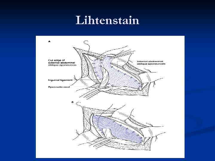 Lihtenstain 