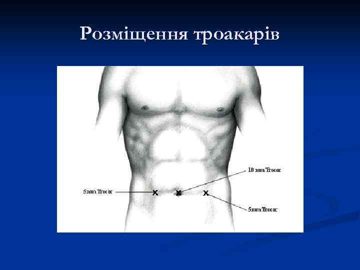 Розміщення троакарів 