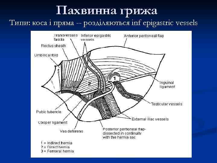 Пахвинна грижа Типи: коса і пряма -- розділяються inf epigastric vessels 