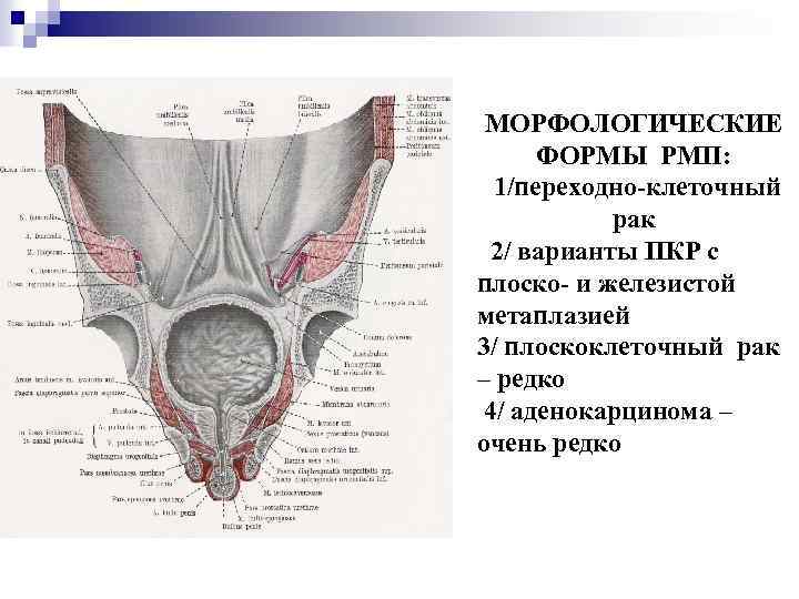 МОРФОЛОГИЧЕСКИЕ ФОРМЫ РМП: 1/переходно-клеточный рак 2/ варианты ПКР с плоско- и железистой метаплазией 3/