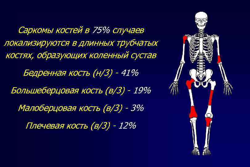 Саркомы костей в 75% случаев локализируются в длинных трубчатых костях, образующих коленный сустав Бедренная