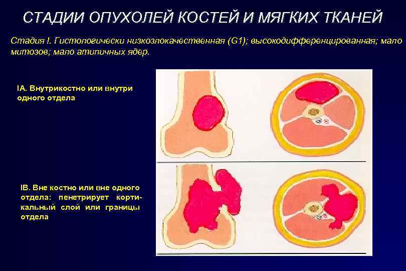 СТАДИИ ОПУХОЛЕЙ КОСТЕЙ И МЯГКИХ ТКАНЕЙ Стадия I. Гистологически низкозлокачественная (G 1); высокодифференцированная; мало