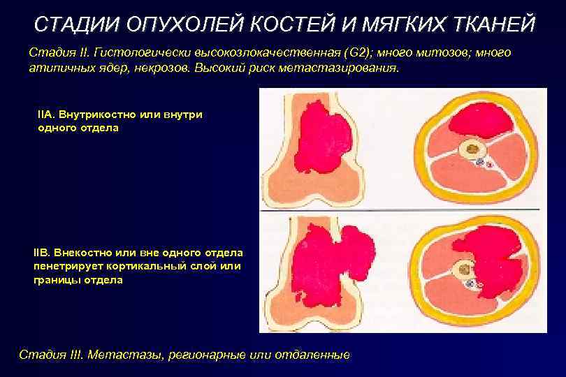 СТАДИИ ОПУХОЛЕЙ КОСТЕЙ И МЯГКИХ ТКАНЕЙ Стадия II. Гистологически высокозлокачественная (G 2); много митозов;