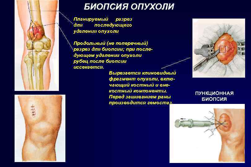 БИОПСИЯ ОПУХОЛИ Планируемый разрез для последующего удаления опухоли Продольный (не поперечный) разрез для биопсии;