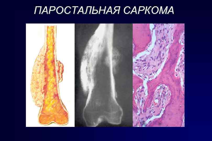 ПАРОСТАЛЬНАЯ САРКОМА 