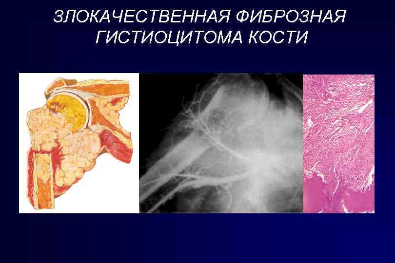 ЗЛОКАЧЕСТВЕННАЯ ФИБРОЗНАЯ ГИСТИОЦИТОМА КОСТИ 