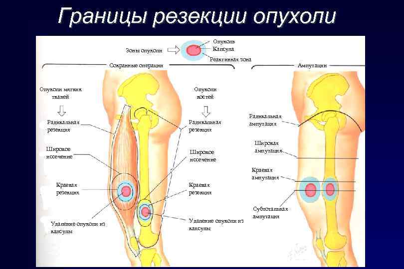 Границы резекции опухоли Опухоль Капсула Зоны опухоли Сохранные операции Опухоли мягких тканей Радикальная резекция