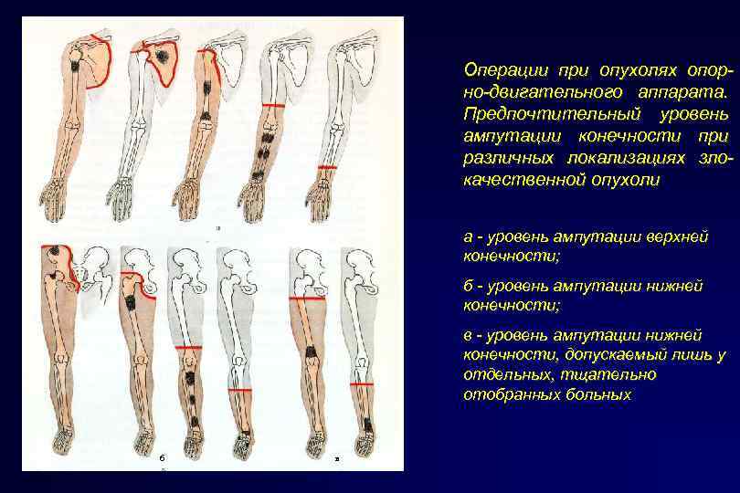 Операции при опухолях опорно-двигательного аппарата. Предпочтительный уровень ампутации конечности при различных локализациях злокачественной опухоли
