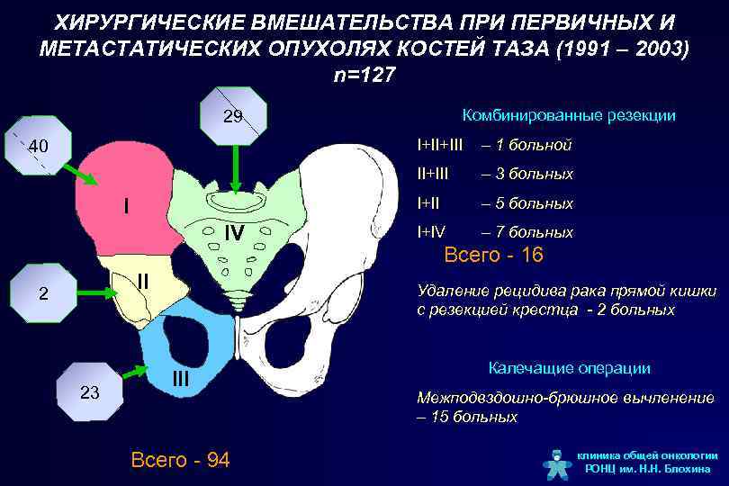 Симптомы рака костей у женщин. Новообразования костей таза. Объемные образования костей таза. Новообразования тазовых костей.