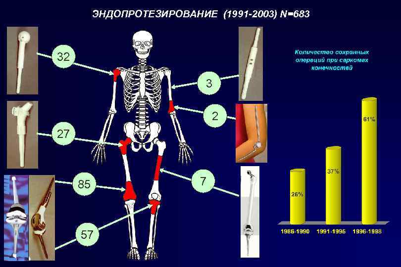 ЭНДОПРОТЕЗИРОВАНИЕ (1991 -2003) N=683 32 3 2 27 85 57 7 