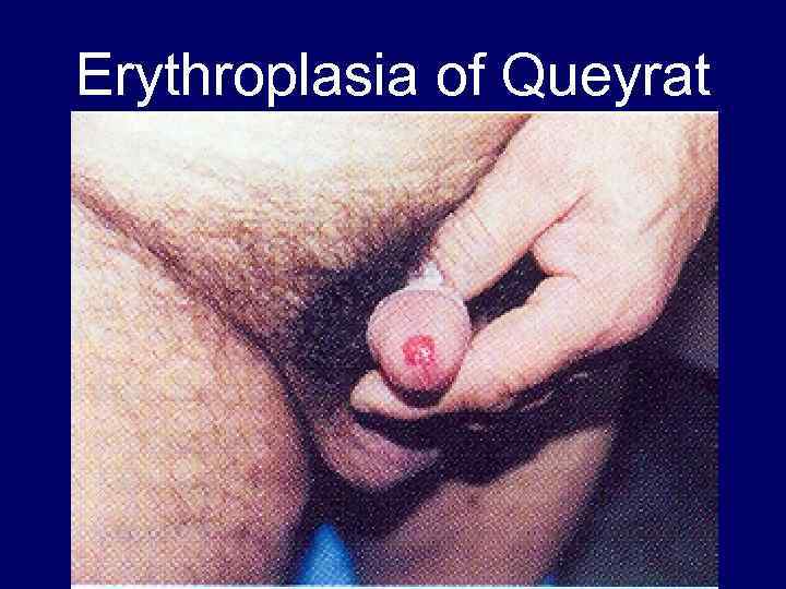 Erythroplasia of Queyrat 