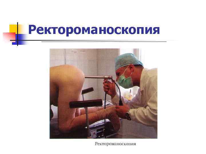 Ректороманоскопия 