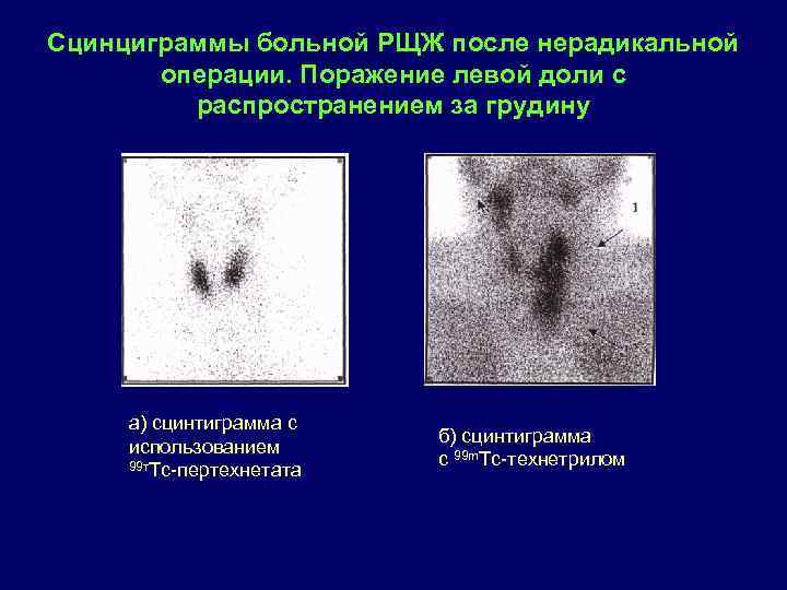 Сцинциграммы больной РЩЖ после нерадикальной операции. Поражение левой доли с распространением за грудину а)